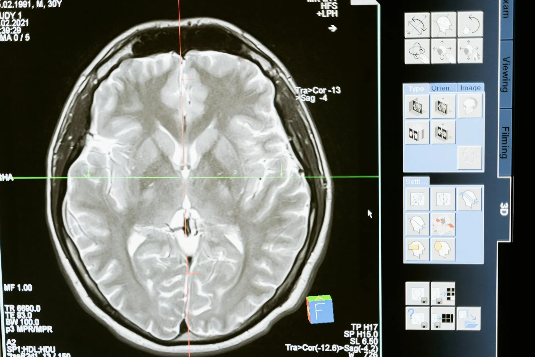 En detaljeret MR-scanning af hjernen vises på en computerskærm til medicinsk analyse og diagnostik. Billedet illustrerer avanceret billedbehandling i sundhedssektoren.