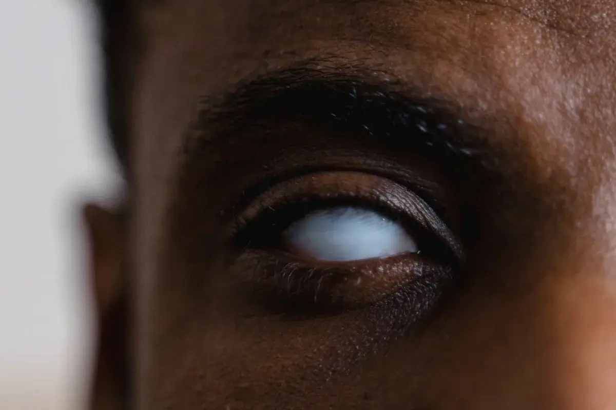 Close-up of a blind eye with milky white appearance