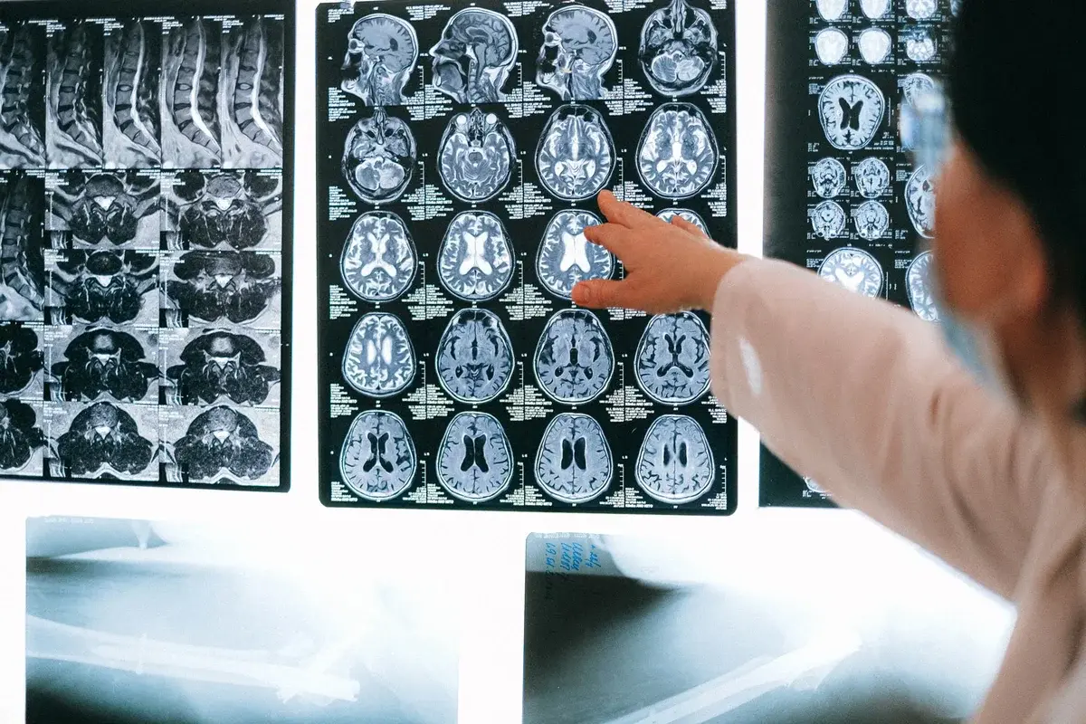 A doctor pointing at brain scan images on a lightbox.