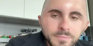 Hårtransplantation gik galt for 27-årig: Endte med ansigt som ‘æg’ – men fortryder ikke